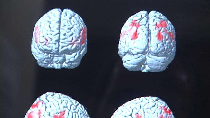 In comparative scans, researchers documented the greatest differences between autism and normal volunteers -- those without autism did not show the same deficits.