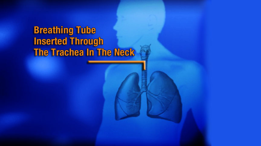 Inhalation burns are rare injuries