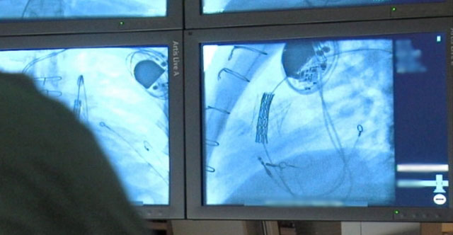 Doctors implant heart valve without open heart surgery