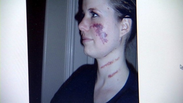At 24, Gerber asked a doctor to remove a small mole on her face for vanity sake. That's when she found out she had stage 3 melanoma. The cancer had spread to her lymph nodes.