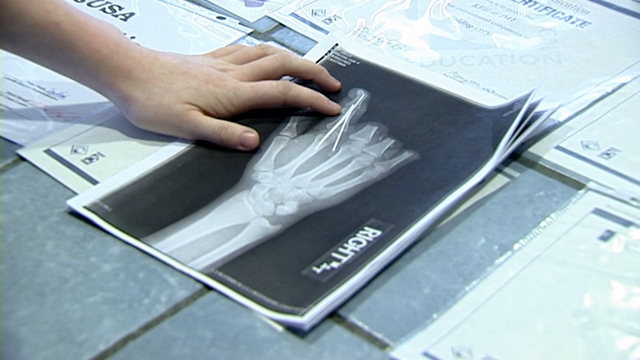 An x-ray of Kellie's hand after the accident.