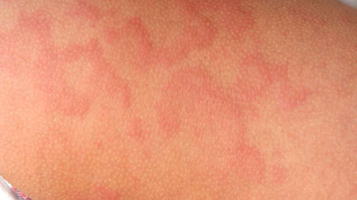 9 confirmed cases of measles in Salt Lake County