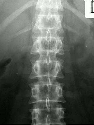 Remote-controlled medical device helps alleviate chronic pain