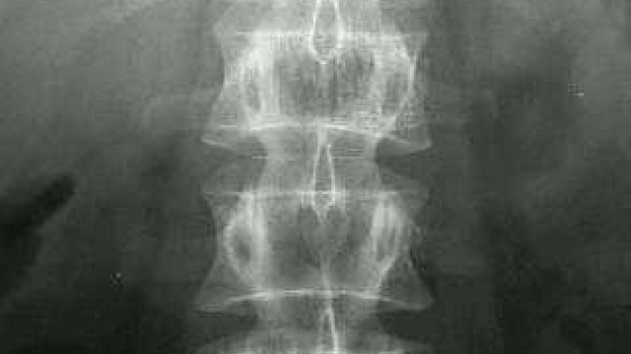 Remote-controlled medical device helps alleviate chronic pain