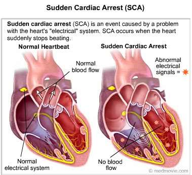 Sudden cardiac arrests stir debate about screening athletes