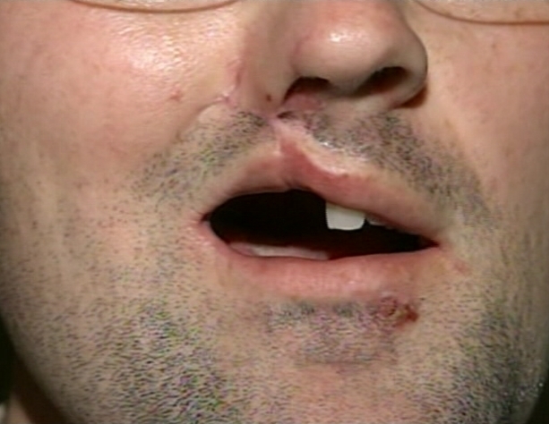 Andrew Linn has scars, lost several teeth and his palate was destroyed. But he's just happy to be alive.