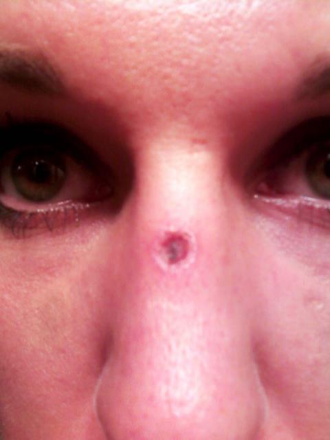 "It looked like a crater — like you go to Hawaii and see craters in the earth. That's what it looked like in my flesh," Karrie Jaramillo said of the wound she received at a medi-spa.