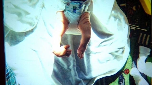 Hunter Woodhall was born without a calf bone in his left leg, and his right ankle was fused at the joint.