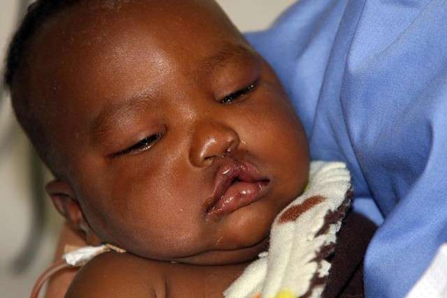A 2-year old cleft palette patient recovers at the Rift Valley General Hospital in Nakuru, Kenya.