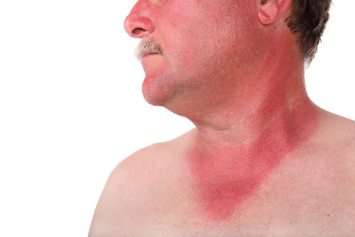 Mommy Medicine: Understanding sunburns and how to treat them