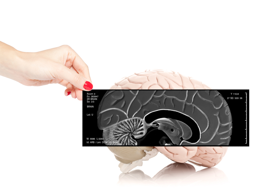 How specific epilepsy treatments can limit seizures