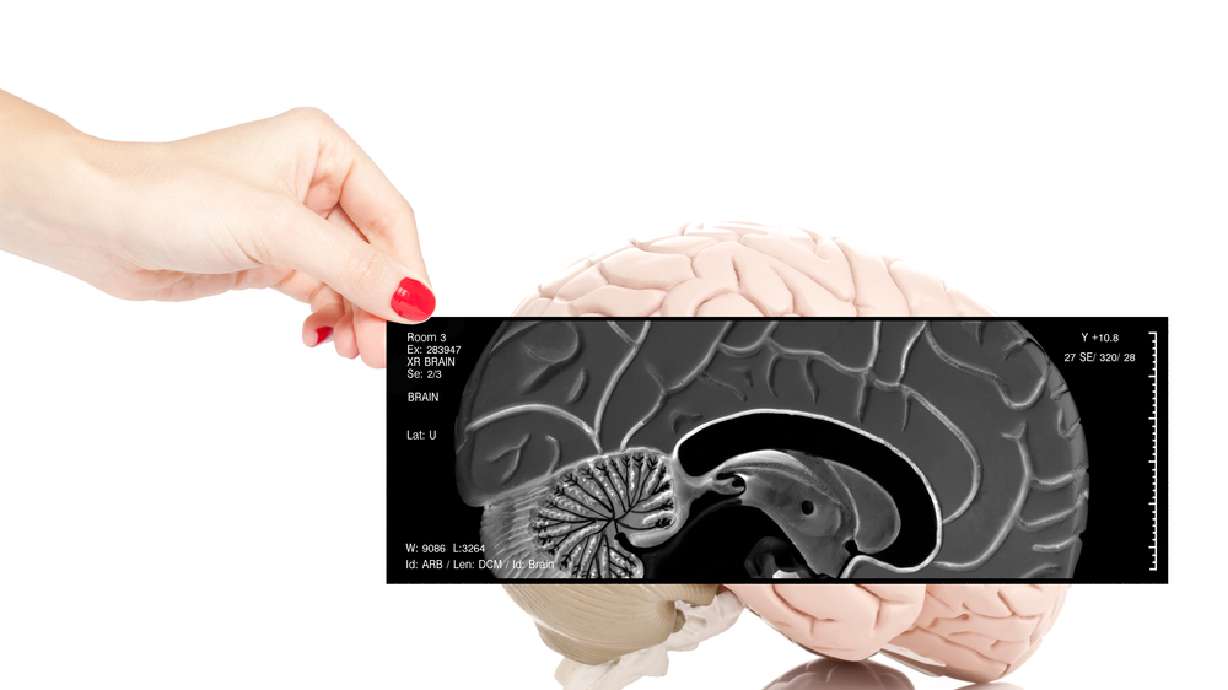 How specific epilepsy treatments can limit seizures