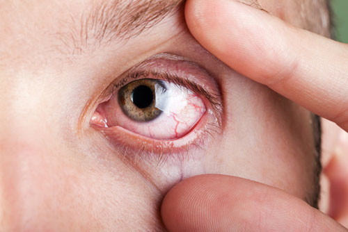 Mommy Medicine: Eye injuries and irritation