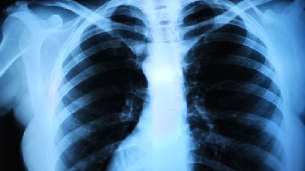 Mommy Medicine: Fractured ribs common, still dangerous