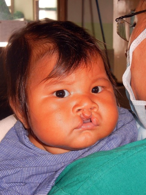 Children in Asia are about twice as likely as white American children to be born with cleft palates. (Photo Courtesy of Jim Webber)