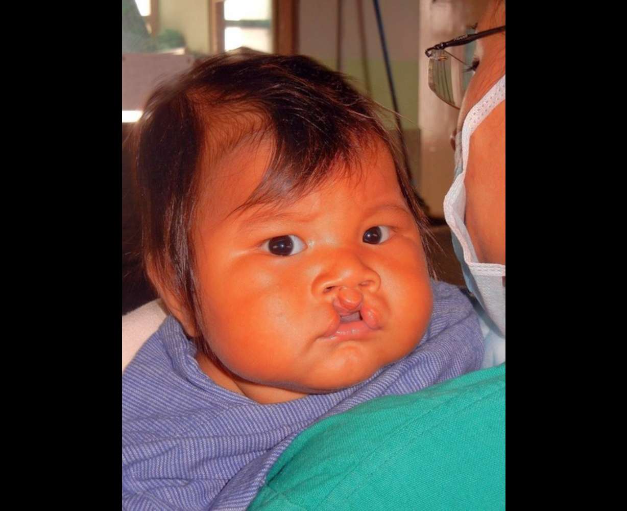 Children in Asia are about twice as likely as white American children to be born with cleft palates. (Photo Courtesy of Jim Webber)