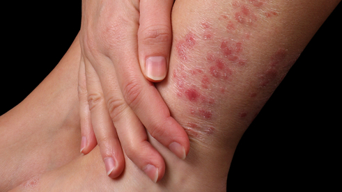 Mommy Medicine: Treating eczema and other rashes