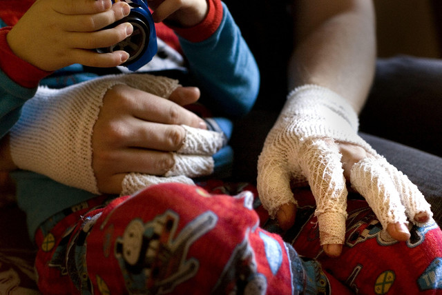 16-year-old Devind Whitehead's hands were burned while rescuing his two younger siblings from their blazing home Monday night.