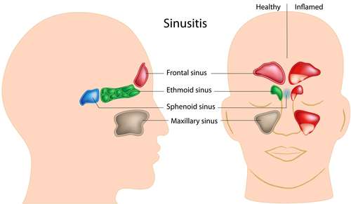 Mommy Medicine: Sinusitis — the ‘cold' that just won't go away