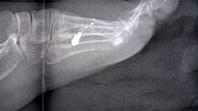 16-year-old Destiny McCubbin threw a house party she said she intended to be like the movie 'Project X.' Instead, four people, including herself, were shot. This x-ray shows the bullet in her foot.