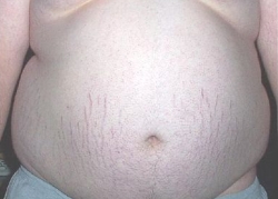 Don't Worry About Your Fat