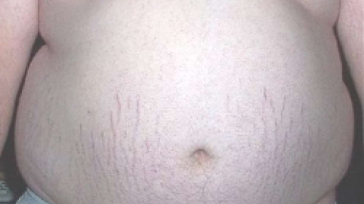 Don't Worry About Your Fat