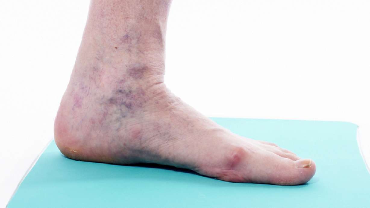 Mommy Medicine: When to be concerned about varicose veins