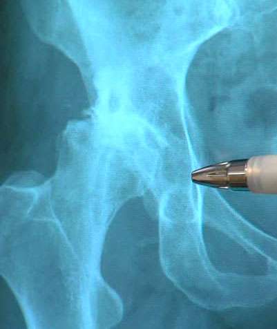 An X-ray of Carole Mikita's hip taken before her joint replacement surgery shows there is no cartilage left in the joint.