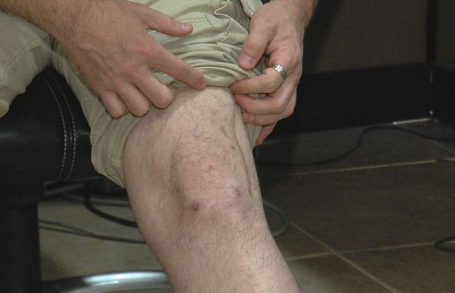 South Jordan Police Officer Stevan Gerber shows 
the scars left behind from the four surgeries 
he's had to repair his shattered bones.