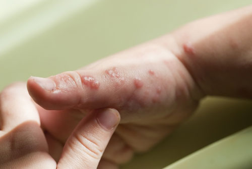 Mommy Medicine: Is it shingles?