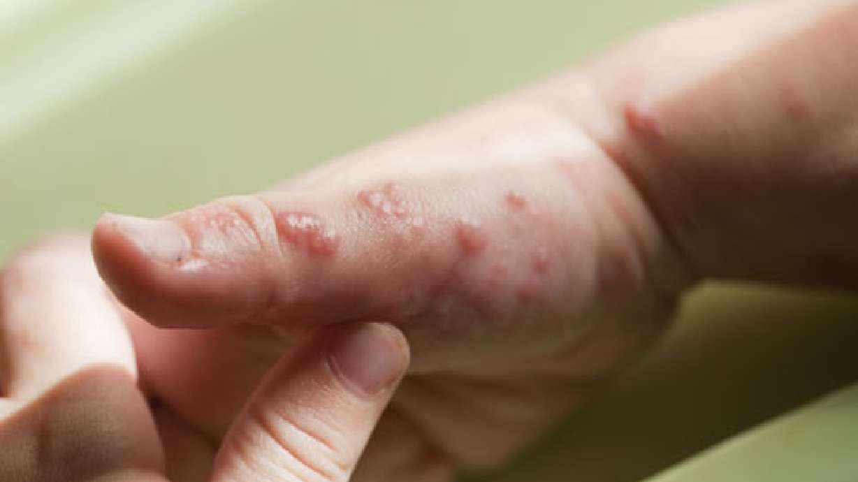Mommy Medicine: Is it shingles?