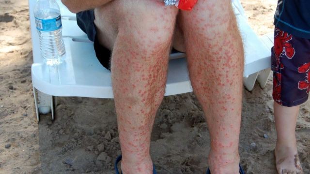 swimmers itch utah