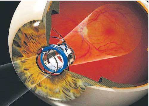 Surgery Turns Woman’s Eye into a Telescope