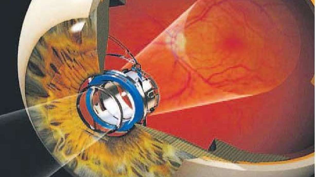 Surgery Turns Woman’s Eye into a Telescope