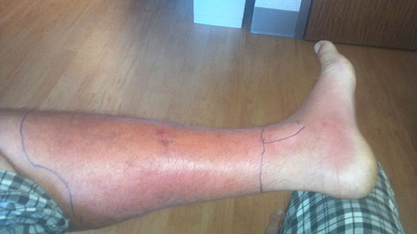 Mommy Medicine: A common but deadly infection