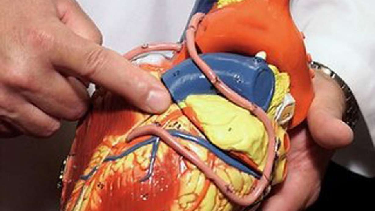 Sudden cardiac arrest no. 1 killer of student athletes