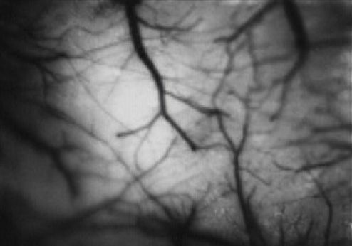 Eerie imaging maps migraine aura