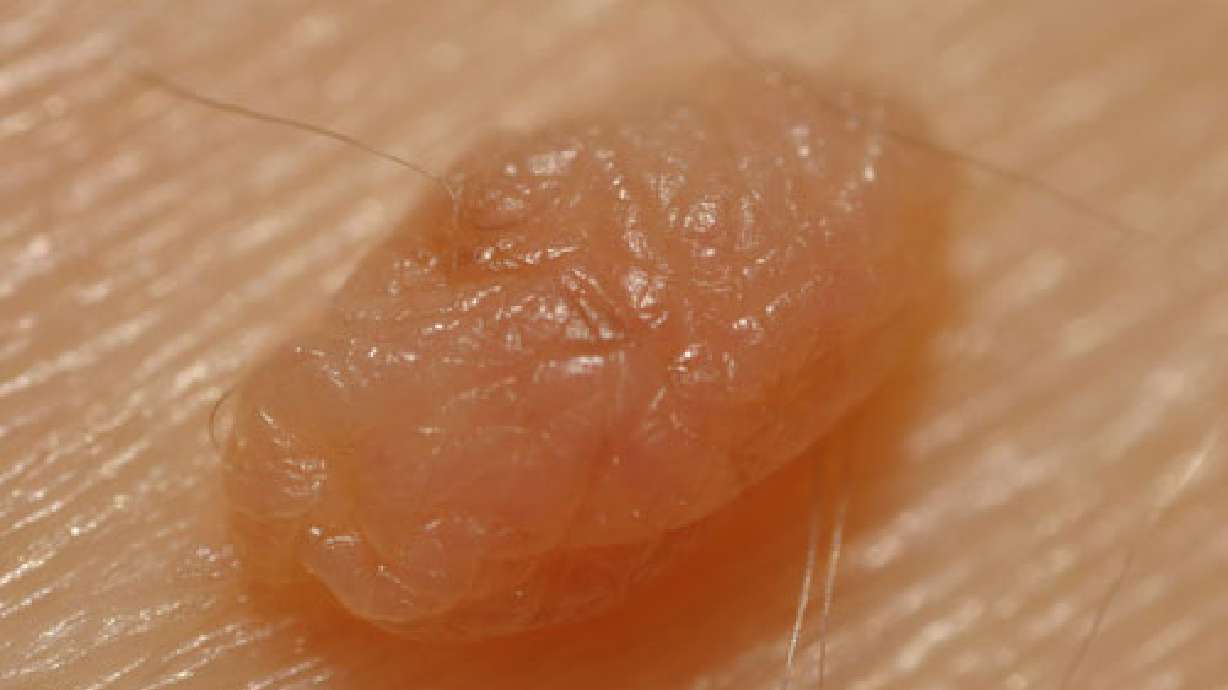 Skin tags: What they are and how to remove them