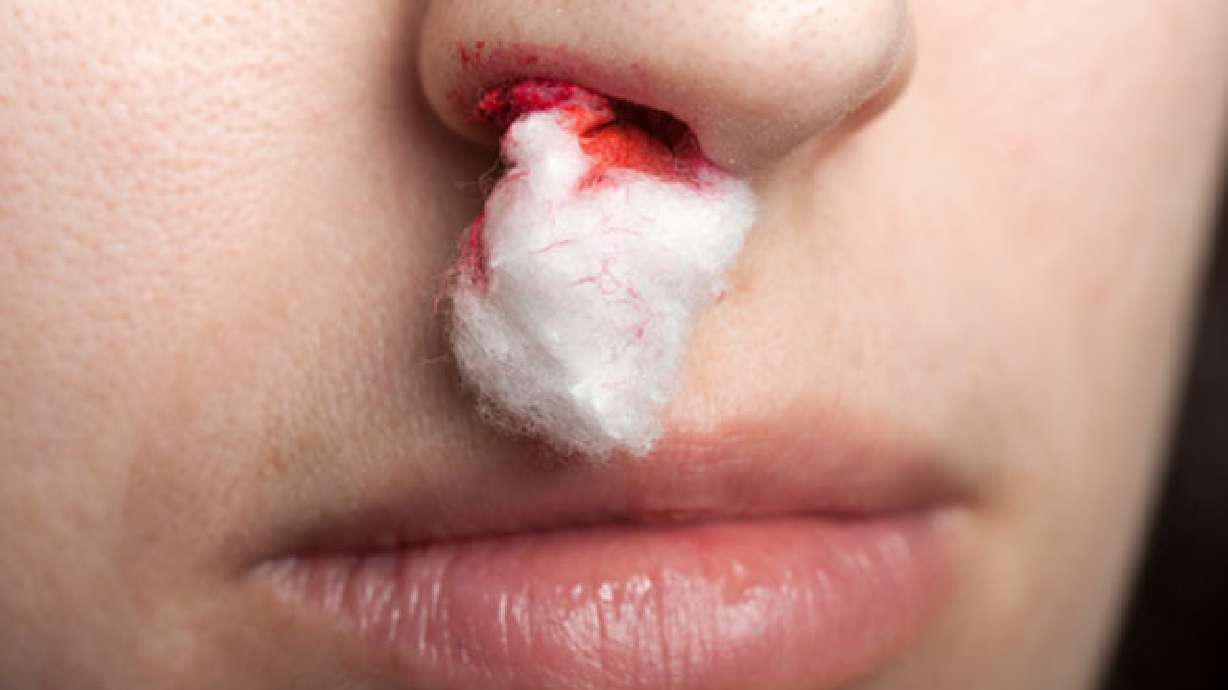 Nosebleeds 101: Causes, prevention tactics and treatments