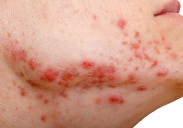 Acne: Its source and most effective treatments