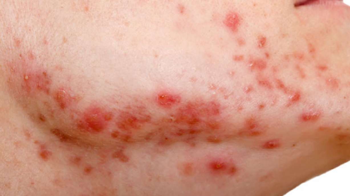 Acne: Its source and most effective treatments