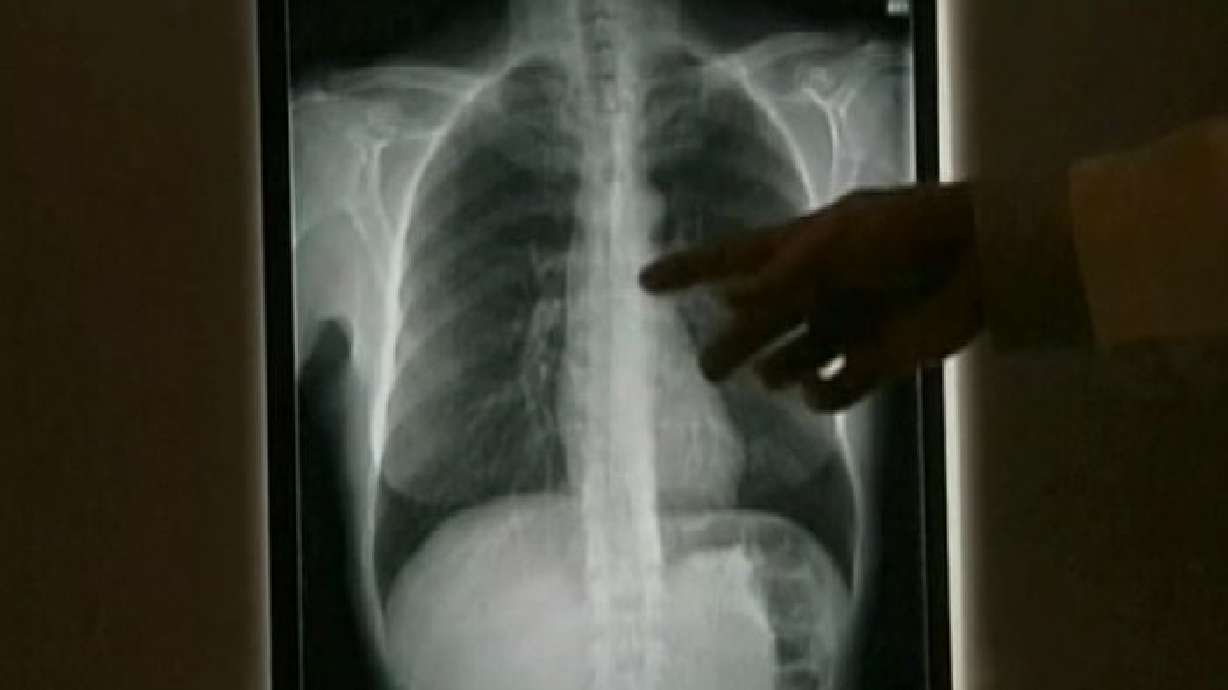 Early detection of lung cancer still tricky, doctors say