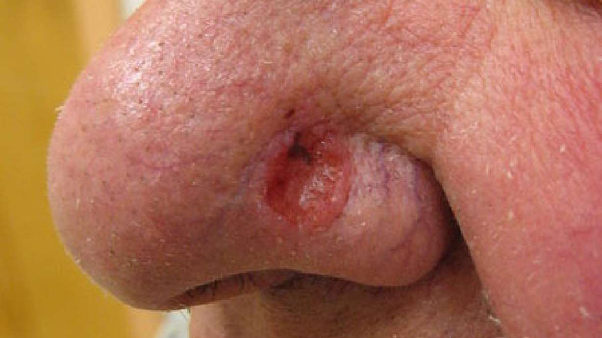 Is that skin cancer?