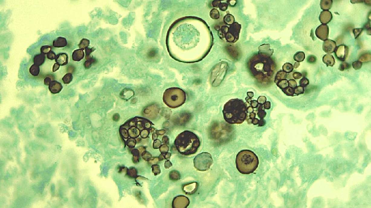 Mysterious fungus runs rampant in Southwest; Utah sees fewer cases
