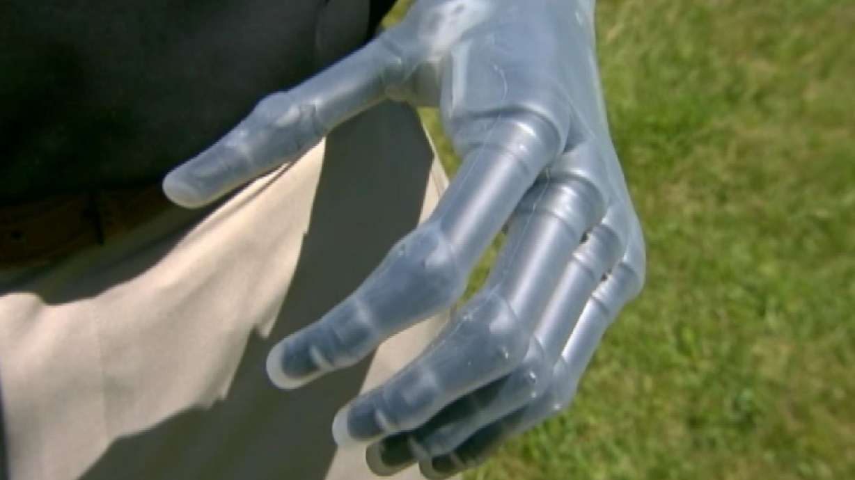 Mass. man gets first of next-gen 'bionic' hands