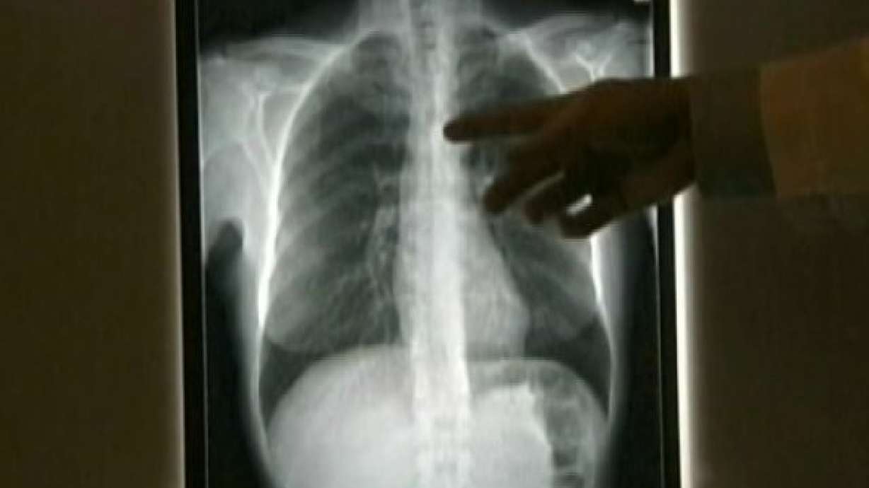 Doctors troubled by growing cases of lung cancer in non-smoking women