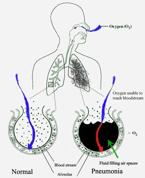 4 of the most common lung disorders and diseases