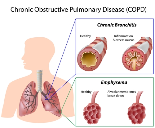 4 of the most common lung disorders and diseases