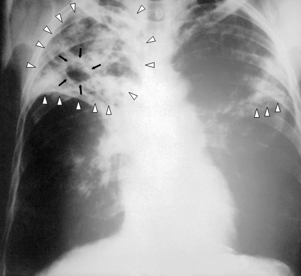 An anteroposterior X-ray of a patient diagnosed with advanced bilateral pulmonary tuberculosis. This AP X-ray of the chest reveals the presence of bilateral pulmonary infiltrate (white triangles), and „caving formation" (black arrows) present in the right apical region.The diagnosis is far-advanced tuberculosis. (Photo: public domain)