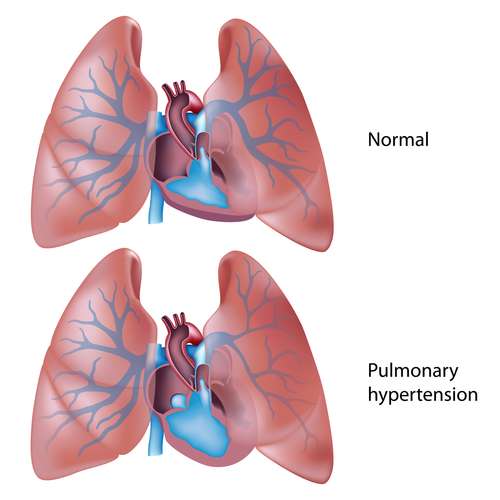 5 deadly lung diseases and the damage they can do